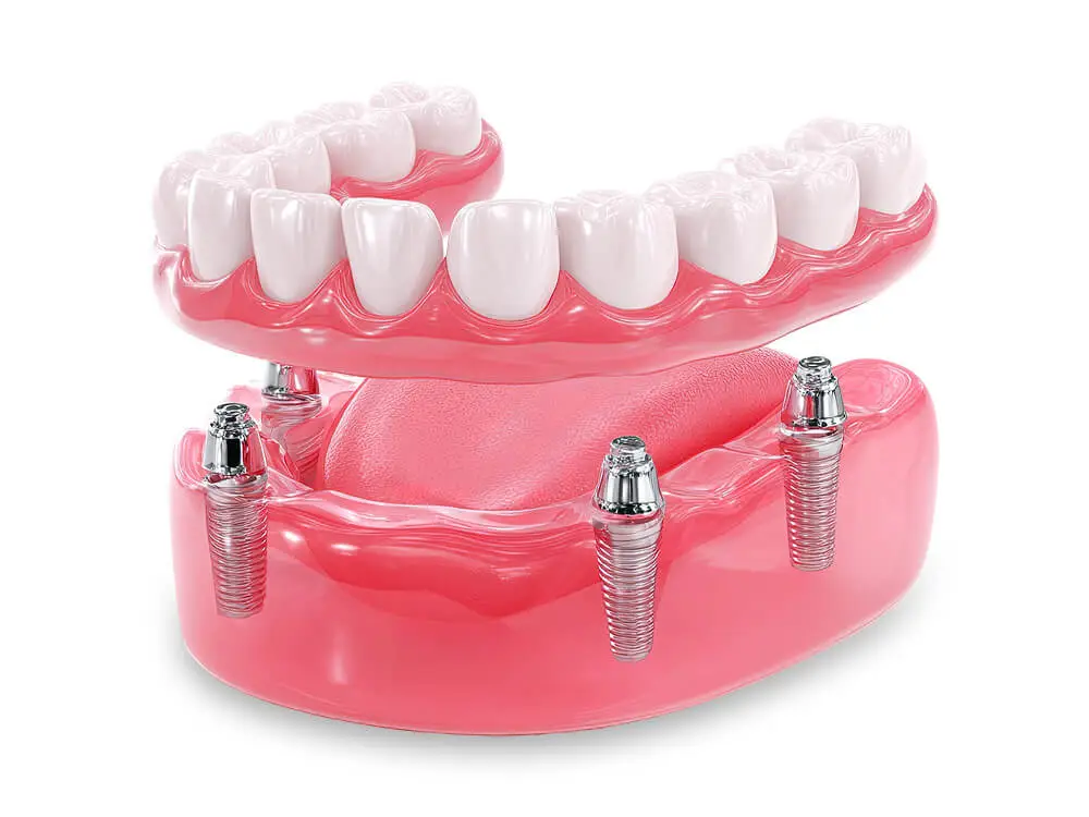 Prótese sobre implantes (Protocolo de Brånemark)