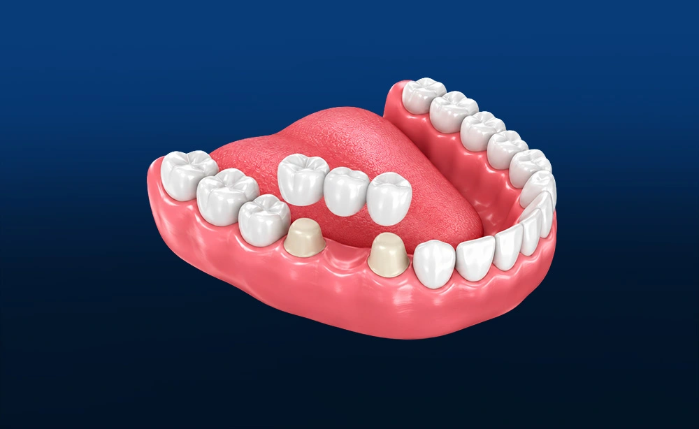 Coroas dentárias